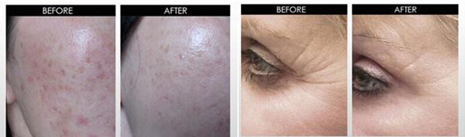 microneedling before and after photos