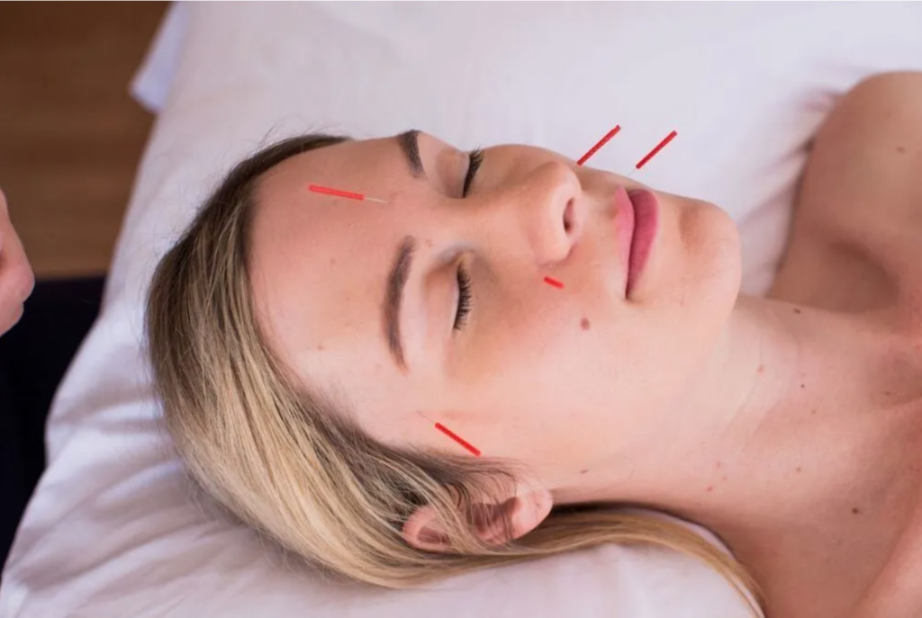 Cosmetic Acupuncture Sidney